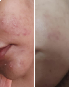 Nirvana Botanics Vitamin C + E Serum – Ml 15 | Anti Acne & Glowing Serum Vitamin C + E